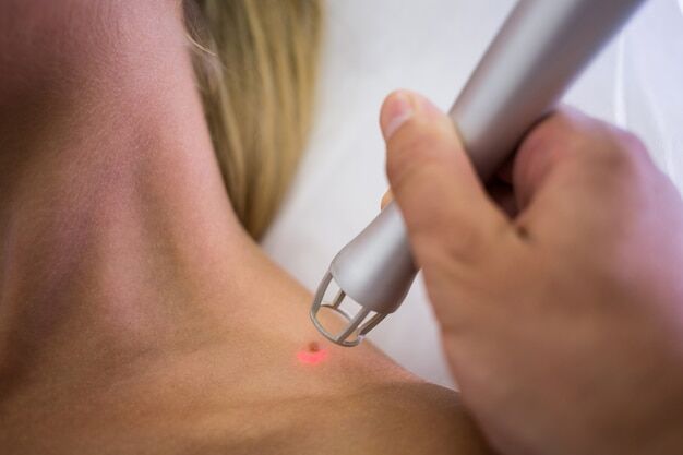 Remoção de tatuagem e micropigmentação em Macapá